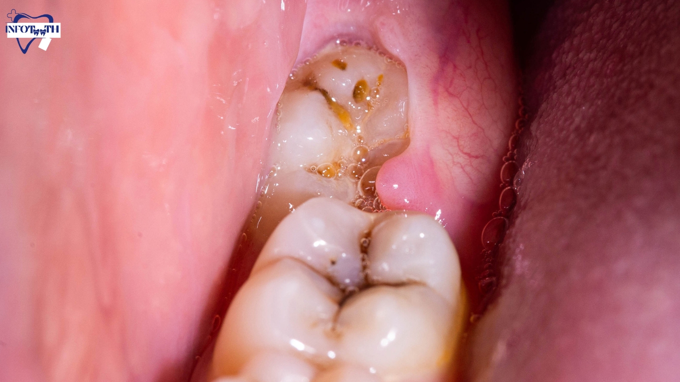 what-are-sugar-bugs-on-teeth-and-how-its-damaging-teeth-infoteeth