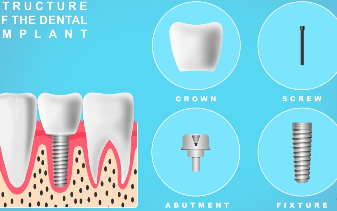 can one implant replace two teeth