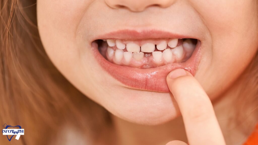 How to reduce Gap between teeth naturally at home?