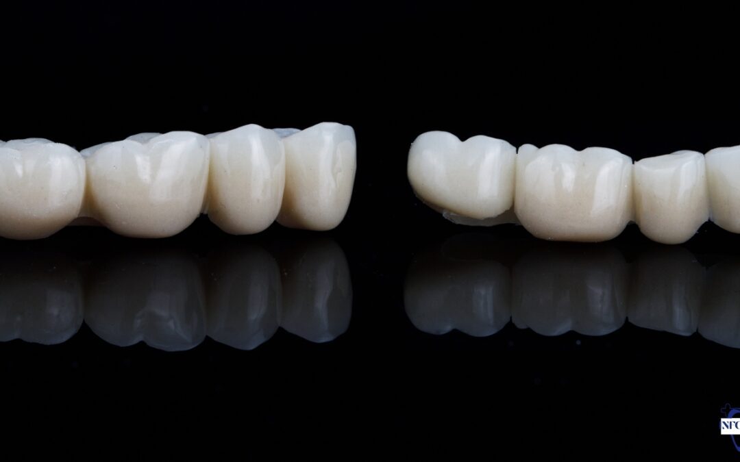 4 Unit Bridge Front Teeth