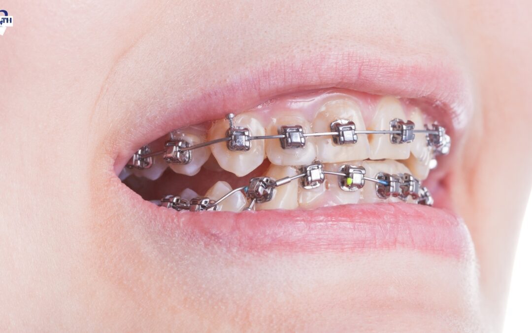 How Long Do Braces Take To Straighten Teeth