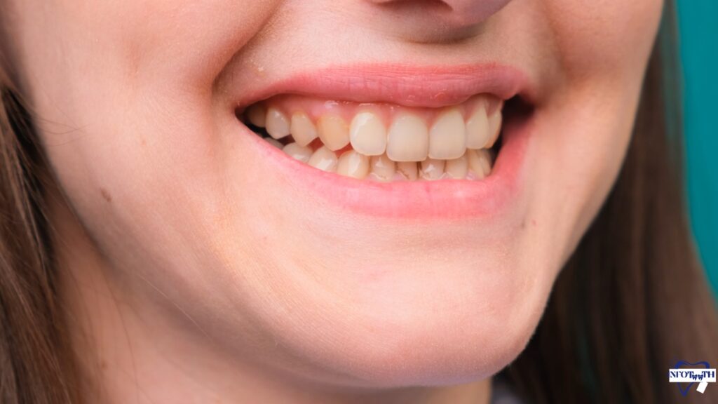 Do Chipped Teeth Grow Back? Infoteeth