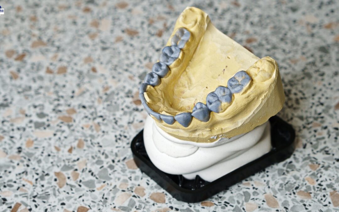 Can Dental Impressions Pull Crowns Out