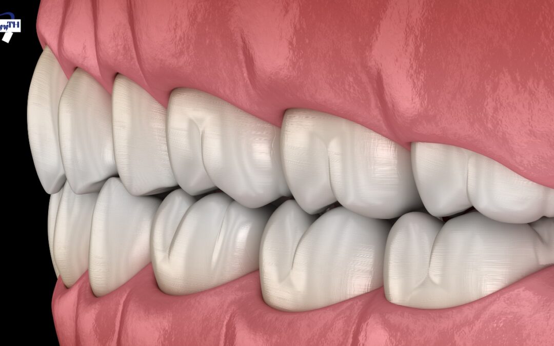 Bicuspid Teeth