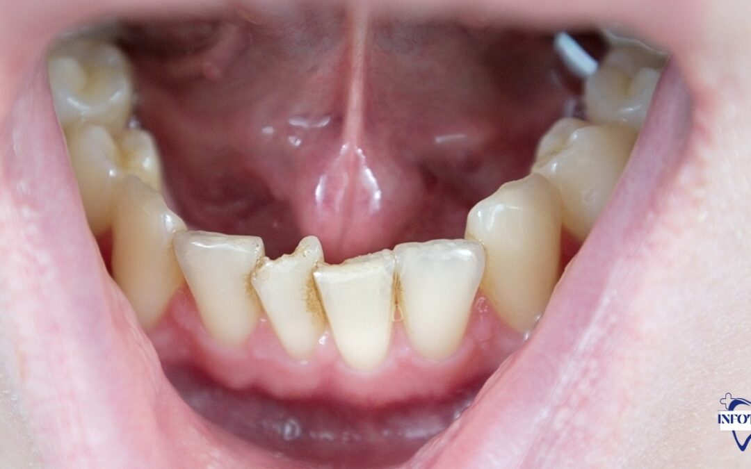 Gemination In Teeth