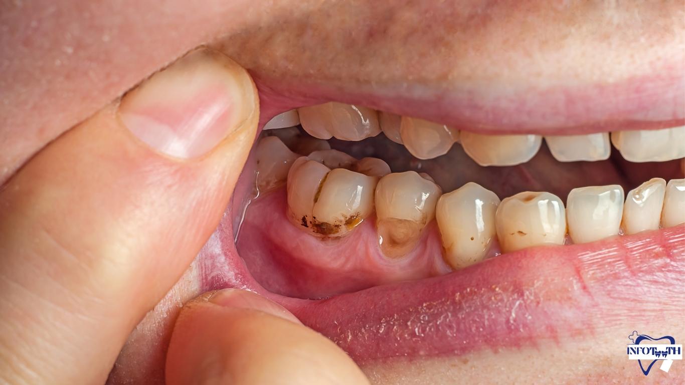 Cavitations In Teeth: Causes, Symtoms & Effects | Infoteeth - Infoteeth